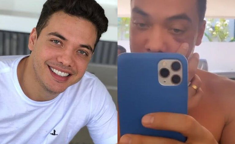 Wesley Safadão aparece com olho roxo e explica o motivo