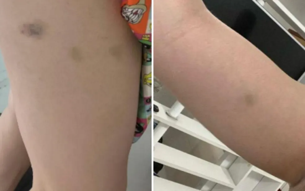 Caso Naiara Azevedo: fotos mostram hematomas no corpo da cantora após denúncia de agressão contra ex-marido Goiânia Goiás — Foto: Reprodução